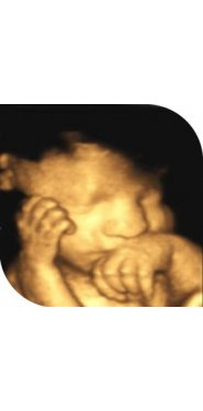 bebé de siete semanas oye por primera vez
