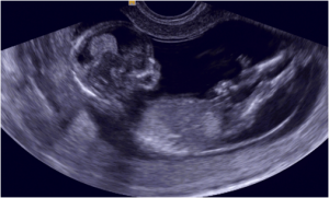 Ecografía de un feto de 16 semanas estirando las piernas